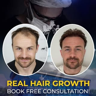 🇹🇷 Hair Transplant Turkey transformations require precision, turning an empty hairline into a fram