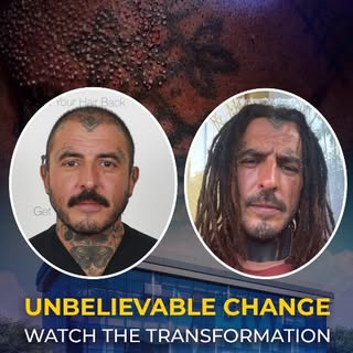 A natural transformation with DHI Hair Transplant. ✨

Our Brazilian patient achieved a natural-looki