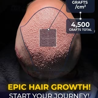 55 grafts per cm². 4,500 grafts. One session.

This is what maximum-density DHI looks like immediate