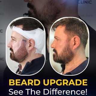 🧔 A beard transplant can help create a fuller, more defined look by restoring areas with patchy or 