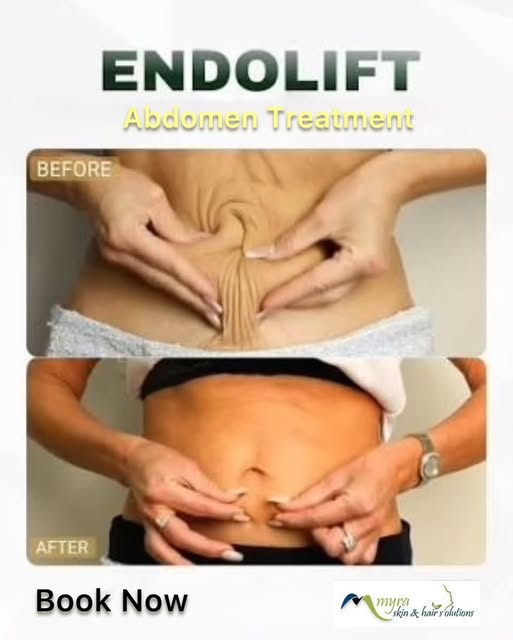 Endolift Treatment