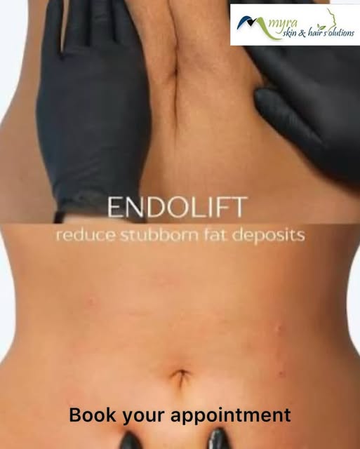 Endolift Treatment