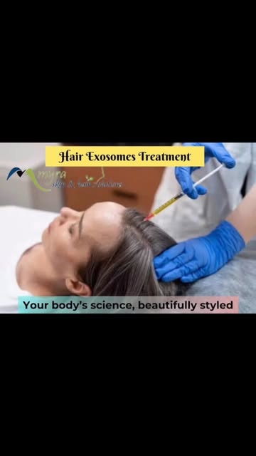 Exosomes Treatment 
#drsoniamangal #myraskinhairsolutions #exosomes #hairtreatment