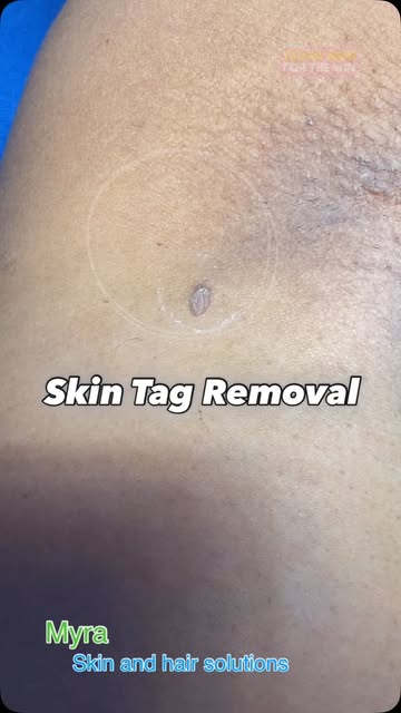 Skin Tag Removal 
#drsoniamangal #myraskinhairsolutions #skintagremoval #dermaclinic