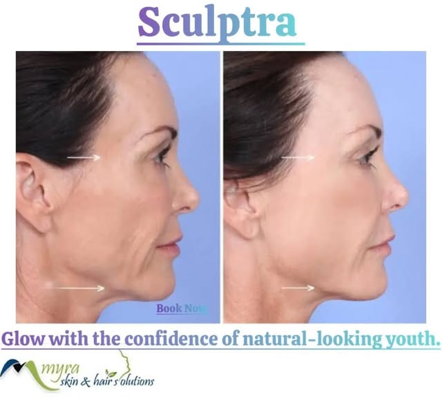 #sculptra #profhilo #skinhydration #skinboosters #skincare