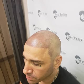 Scalp micropigmentation is a tattoo that replicates hair follicles. Let's build your confidence back