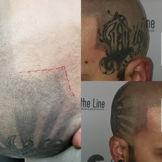 Needed a barbers touch. Scalp micropigmentation is a tattoo that replicates hair follicles. Yes a (t