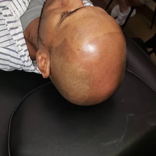1st treatment 2 more to go, scalp micropigmentation is a tattoo that replicates hair follicles. Yes 