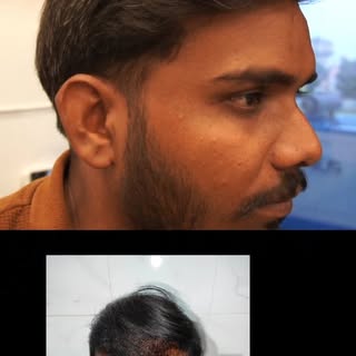 Your hair is 80% of your selfie.
#plasticsurgery #hairtransplant