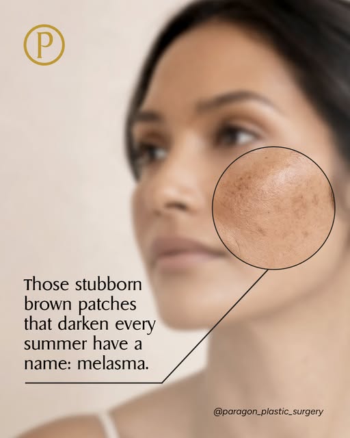 If sun spots fade but certain patches on your cheeks or upper lip only deepen every summer, you may 