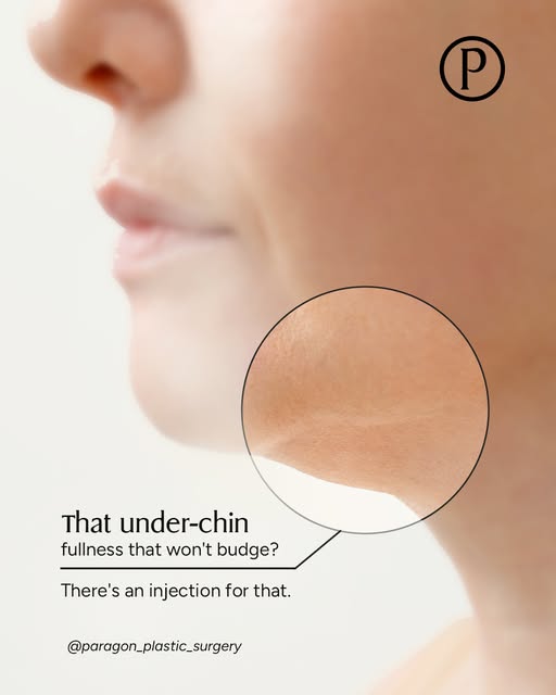 A double chin can hang around no matter how lean the rest of you gets.

Kybella is an injectable tha