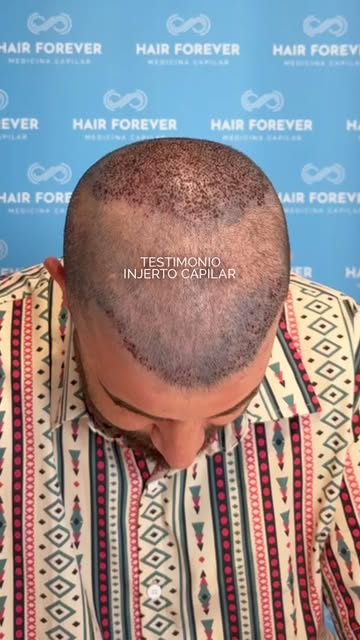 💬 Alejandro nos cuenta su experiencia en Hair Forever tras realizarse un trasplante capilar.

Se re