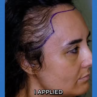 This is what 12 months can change…
No shave.
No stress.
No hiding.
Just REAL results.
Female hair tr