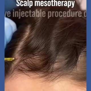 Stronger, healthier hair starts at the root 💉✨
Scalp mesotherapy delivers essential vitamins, amino