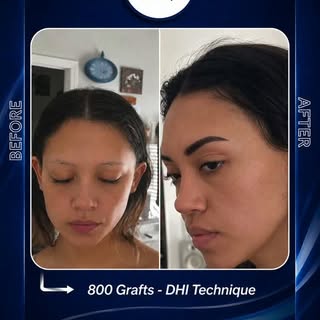 ✨ Natural transformations, real confidence results.

From subtle eyebrow restoration to natural-look
