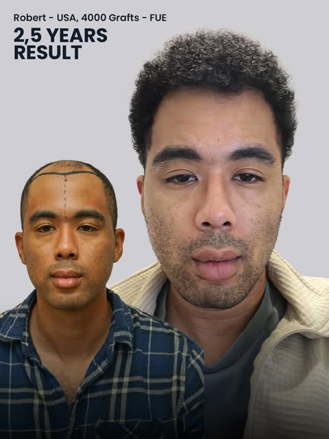 Two and a half years after his procedure, Robert's hair restoration journey highlights what a tailor