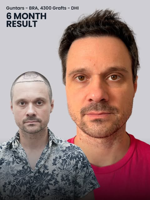 6 months, 4,300 grafts, and a complete shift in confidence. Guntars came to us looking to restore hi