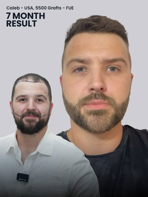 7 months ago, Caleb took the first step to restore his hair and reclaim his confidence. Using 5,500 
