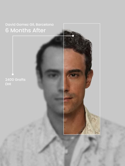Six months can make a world of difference. Take a look at David's hair restoration journey, where we