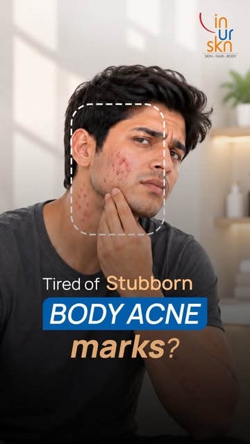 Men’s skin needs attention too, especially when it comes to acne marks on the back, shoulders and ch