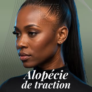 L’alopécie de traction peut être réversible lorsqu’elle est prise en charge à temps.

Tresses, queue