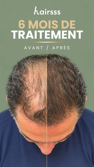 Il envisageait une greffe capillaire. Après six mois de traitement médical personnalisé, son évoluti