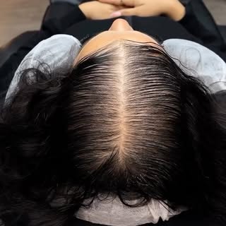 La micropigmentación capilar no es solo para hombres.
También ayuda a mujeres a recuperar densidad, 
