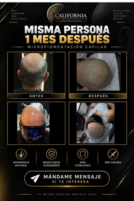 Resultados reales de Micropigmentación Capilar. 💯
Más densidad, una apariencia natural y un cambio 