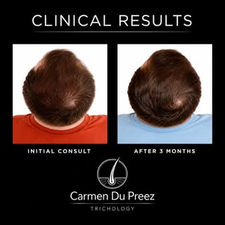 NON SURGICAL HAIR RESTORATION!

These results were achieved in just 3 months with a personalised tre