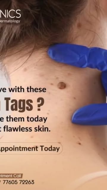 Tired of dealing with pesky skin tags? 🤔 Well, worry no more! Skinnics Advanced Dermatology in Hyde