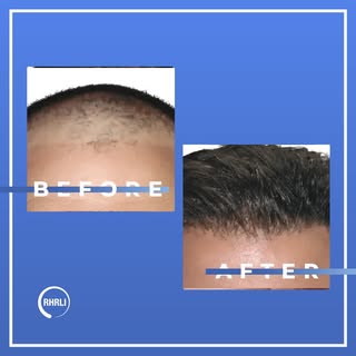 At RHRLI, we offer effective hair restoration options specifically designed for women, from non-surg