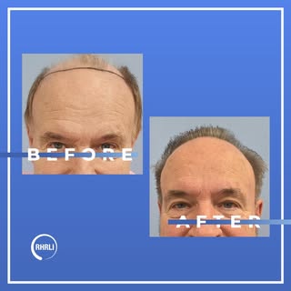 Our hair restoration procedures can make a dramatic improvement in your hairline. To see for yoursel