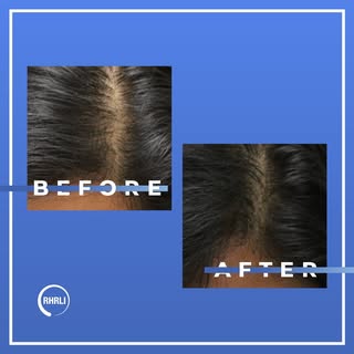 New hair grows naturally, on its own schedule. Most patients begin seeing meaningful growth around 6