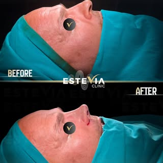 Before & After — Rhinoplasty Success

Patient: Kristian
Surgeon: Dr. Gökhan Efe, Estevia Clinic
Date