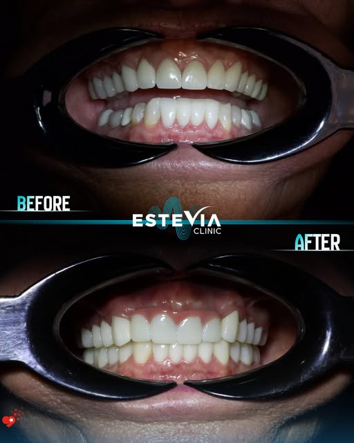 ✨ From loose, failing front teeth to a confident new smile.

Brenda travelled from the USA to Estevi