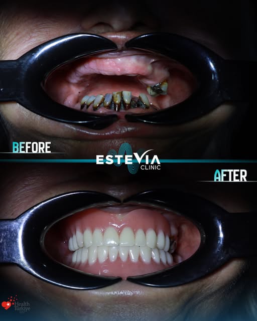 ✨ A journey to a restored smile and renewed confidence.

Lorraine  travelled to Estevia Clinic for h