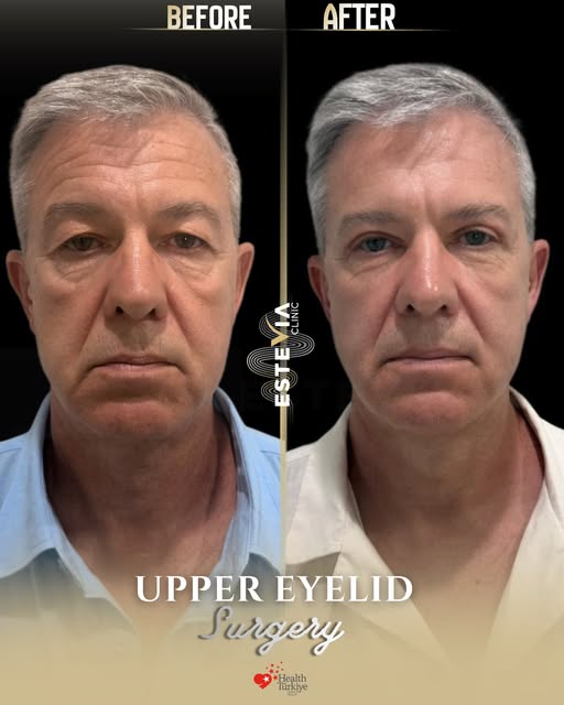 ✨ A refreshed look starts with subtle changes.

Bianca visited Estevia Clinic for Upper Eyelid Surge