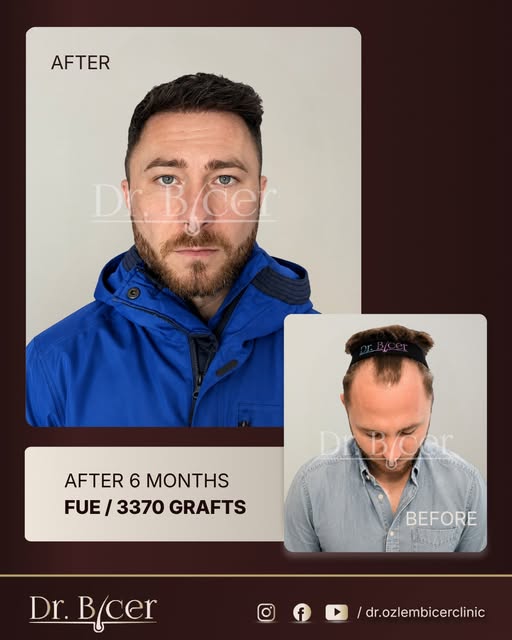 6 months. 3,370 grafts. One carefully planned transformation.

Hair transplantation is not only abou