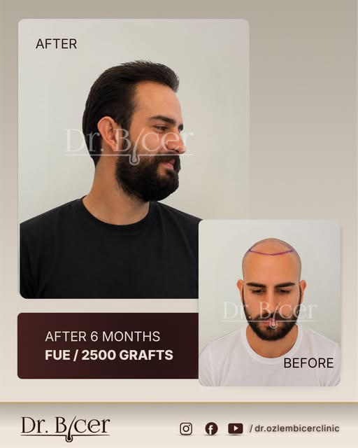 Hairrestoration is a journey and every milestone tells part ofthe story.
This patient's progress 6 m