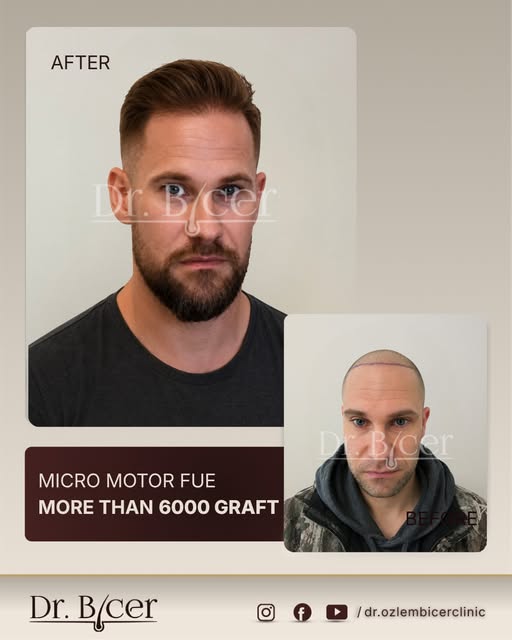 More than 6,000 grafts  planned with purpose.

In extensive hair loss cases, the challenge goes beyo