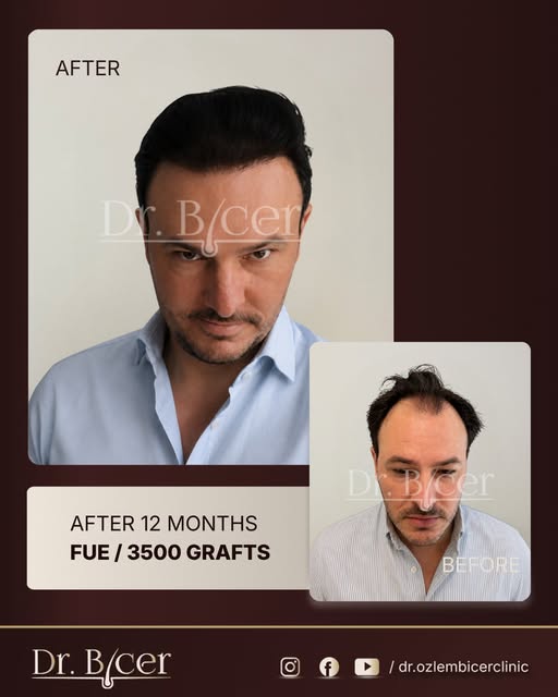 A hairline should belong to the face  not follow a template.

After 12 months and 3,500 grafts with 