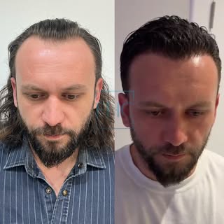 ~EHC~ 

Only in 6 Months.

Stay tuned!

▫️Hair transplant
▫️Eyebrow transplant
▫️Beard Transplant
▫️
