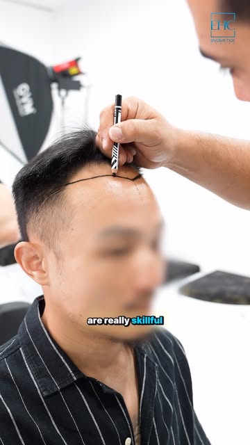 ~EHC~ 

▫️Hair transplant
▫️Eyebrow transplant
▫️Beard Transplant
▫️Unshaven Hair Transplant
▫️DHI H