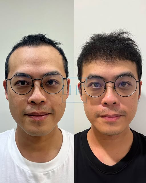 ~EHC~ 

▫️Hair transplant
▫️Eyebrow transplant
▫️Beard Transplant
▫️Unshaven Hair Transplant
▫️DHI H