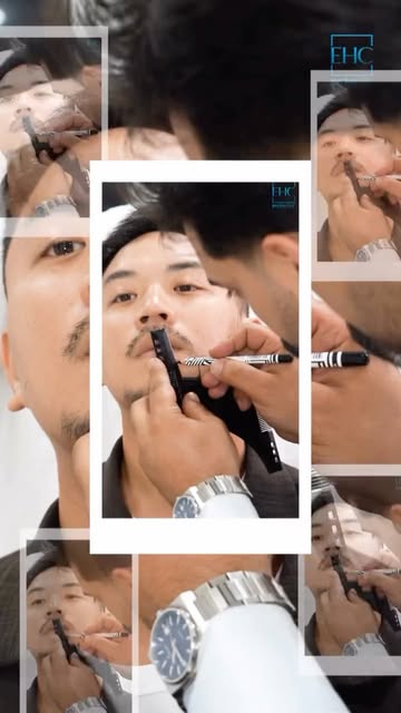 BEARD IMPLANT.

~EHC~ 

▫️Hair transplant
▫️Eyebrow transplant
▫️Beard Transplant
▫️Unshaven Hair Tr