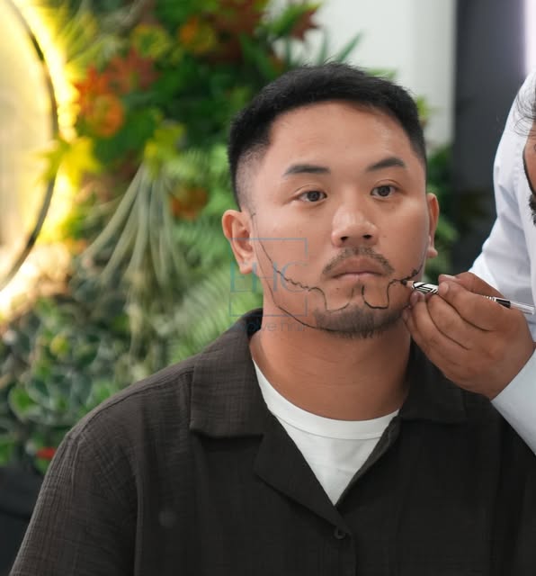 ~EHC~ 

▫️Hair transplant
▫️Eyebrow transplant
▫️Beard Transplant
▫️Unshaven Hair Transplant
▫️DHI H