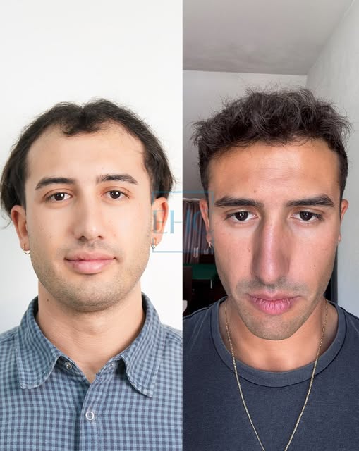 ~EHC~ 

▫️Hair transplant
▫️Eyebrow transplant
▫️Beard Transplant
▫️Unshaven Hair Transplant
▫️DHI H