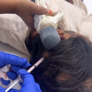 Managing Alopecia Areata with Intralesional PRP/GFC injections for quick and visible results.
#prp #