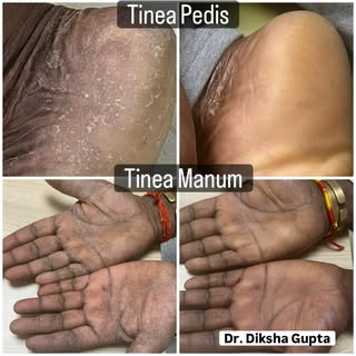 Correct Diagnosis, correct treatment and those chronic diseases can surely be treated. #Tinea #derma