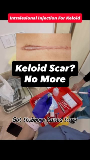 Tired of thick, itchy keloid scars? 🛑 Creams and home remedies rarely penetrate deep enough to flat